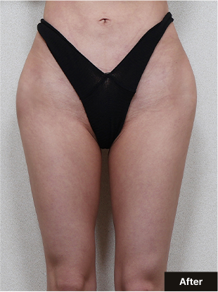 기린 바디필러 after 이미지