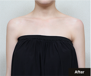 기린 바디필러 after 이미지