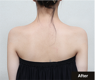 기린 바디필러 after 이미지