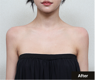 기린 바디필러 after 이미지