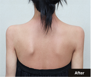 기린 바디필러 after 이미지