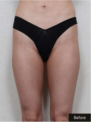 기린 바디필러 Before 이미지