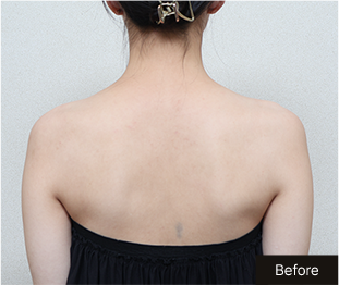 기린 바디필러 Before 이미지