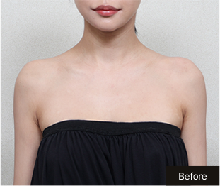 기린 바디필러 Before 이미지