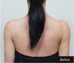 기린 바디필러 Before 이미지