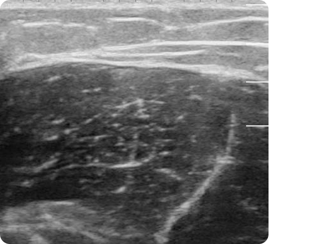 힙 초음파 사진 : 상단부터 진피, 피하지방, 근막, 근육의 층 이미지